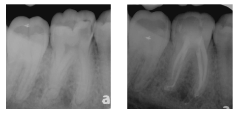 Root Canal Therapy on Molar